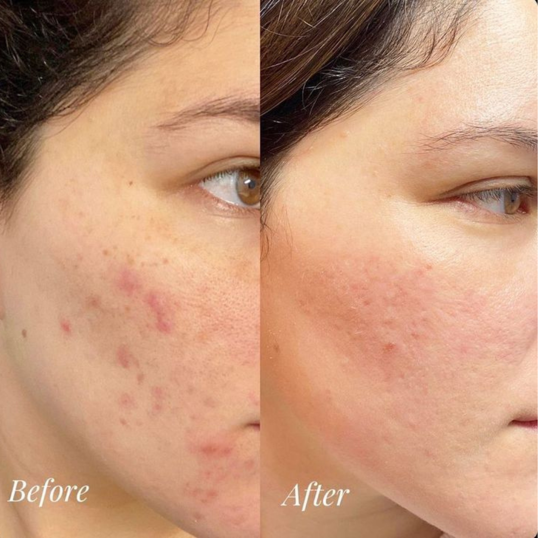 PAIR Acne Cream – Clears Acne, Fades Redness, Prevents New Breakouts – IPPN + IPMP Dual Action – Gentle, Non-Greasy, Dermatologically Tested