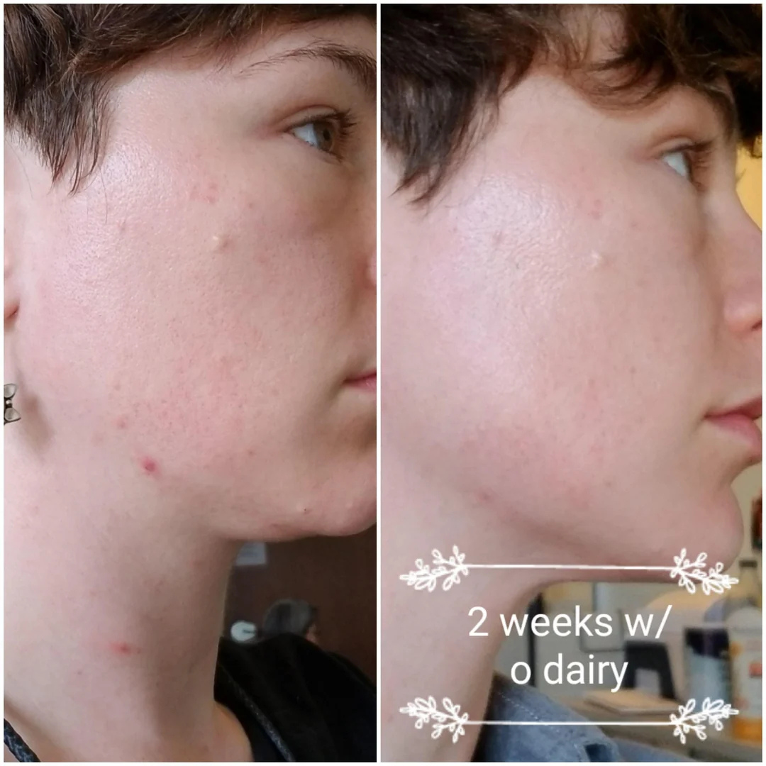 The Ordinary Glycolic Acid 7% Toning Solution – 50% OFF – Reveal Your Smoothest, Brightest Skin – Exfoliates Dead Skin Cells, Brightens Complexion, Unclogs Pores – With 7% Glycolic Acid
