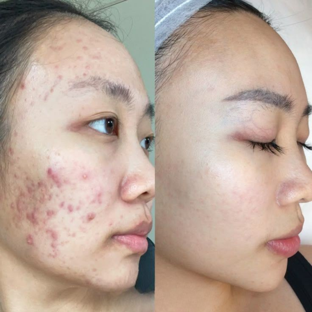 PAIR Acne Cream – Clears Acne, Fades Redness, Prevents New Breakouts – IPPN + IPMP Dual Action – Gentle, Non-Greasy, Dermatologically Tested