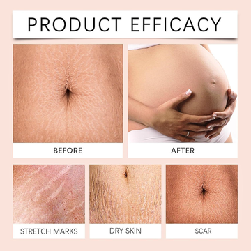 Hakim Suleman's Stretch Mark & Scar Removal Cream | Enriched with Almond, Olive & Sandalwood Oil | Reduces Stretch Marks, Scars & Improves Skin Elasticity