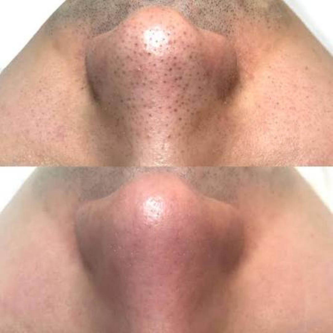 Arencia Eraser Shot Glycolic Acid Booster | Clears Pores | Smooths Texture | Reduces Blemishes