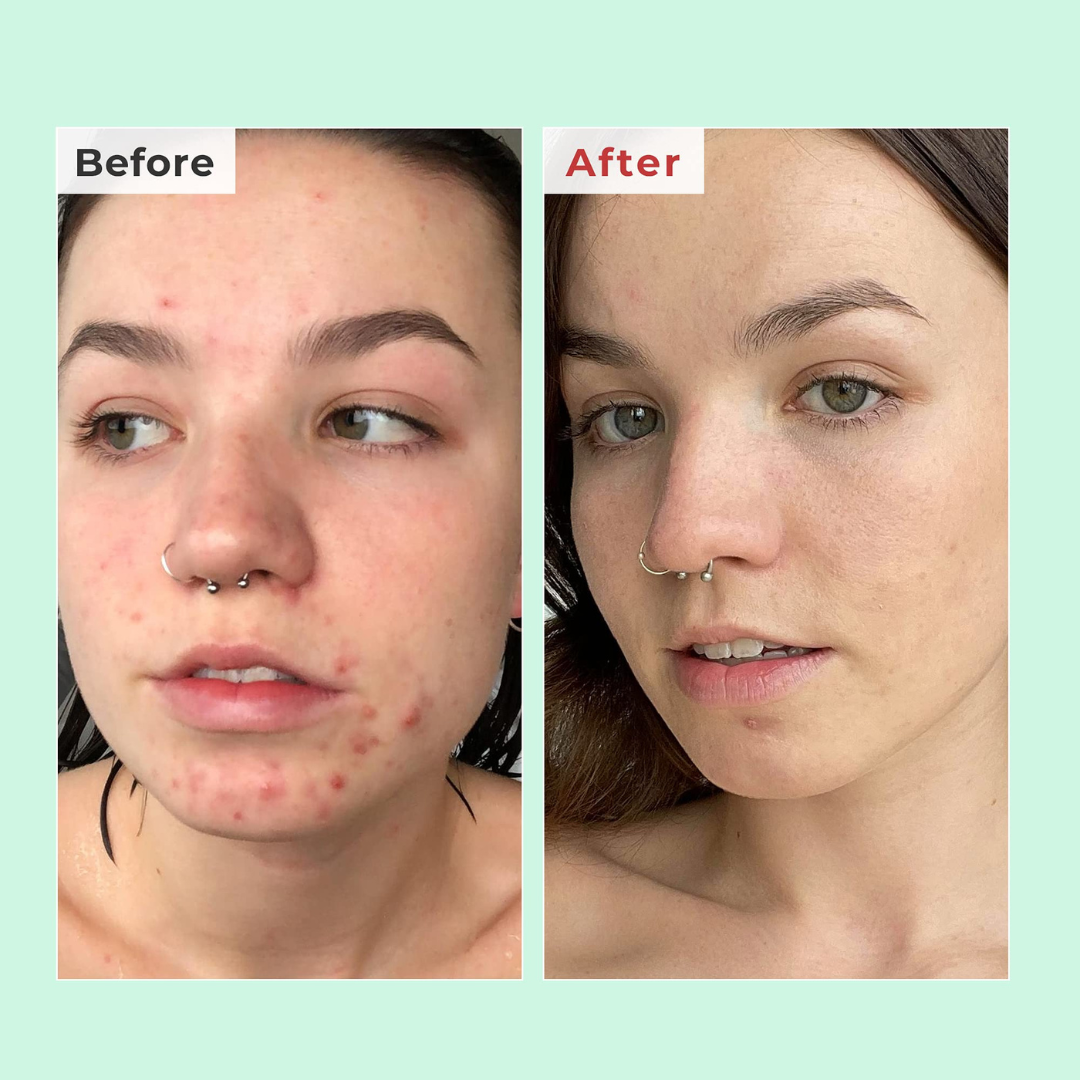 Arencia Eraser Shot Glycolic Acid Booster | Clears Pores | Smooths Texture | Reduces Blemishes