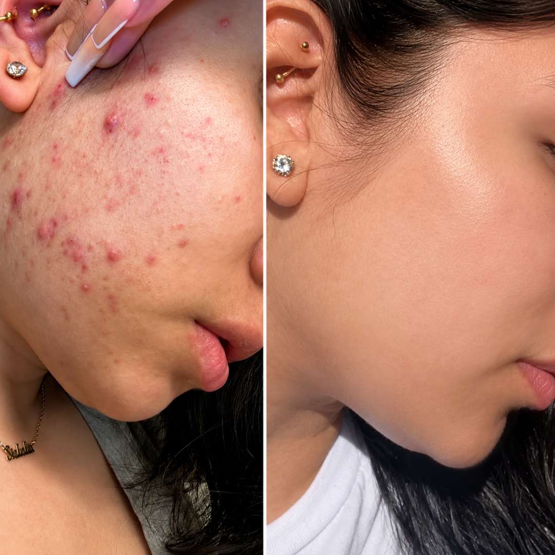 Conscious Chemist Acne Treatment Serum – Reduces Acne, Clears Spots, Smooths Skin – For Acne-Prone Skin
