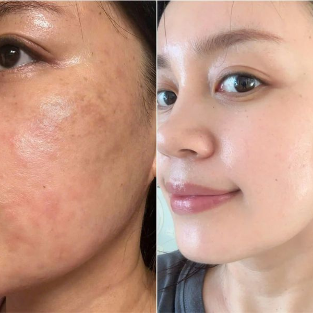 Conscious Chemist Acne Treatment Serum – Reduces Acne, Clears Spots, Smooths Skin – For Acne-Prone Skin