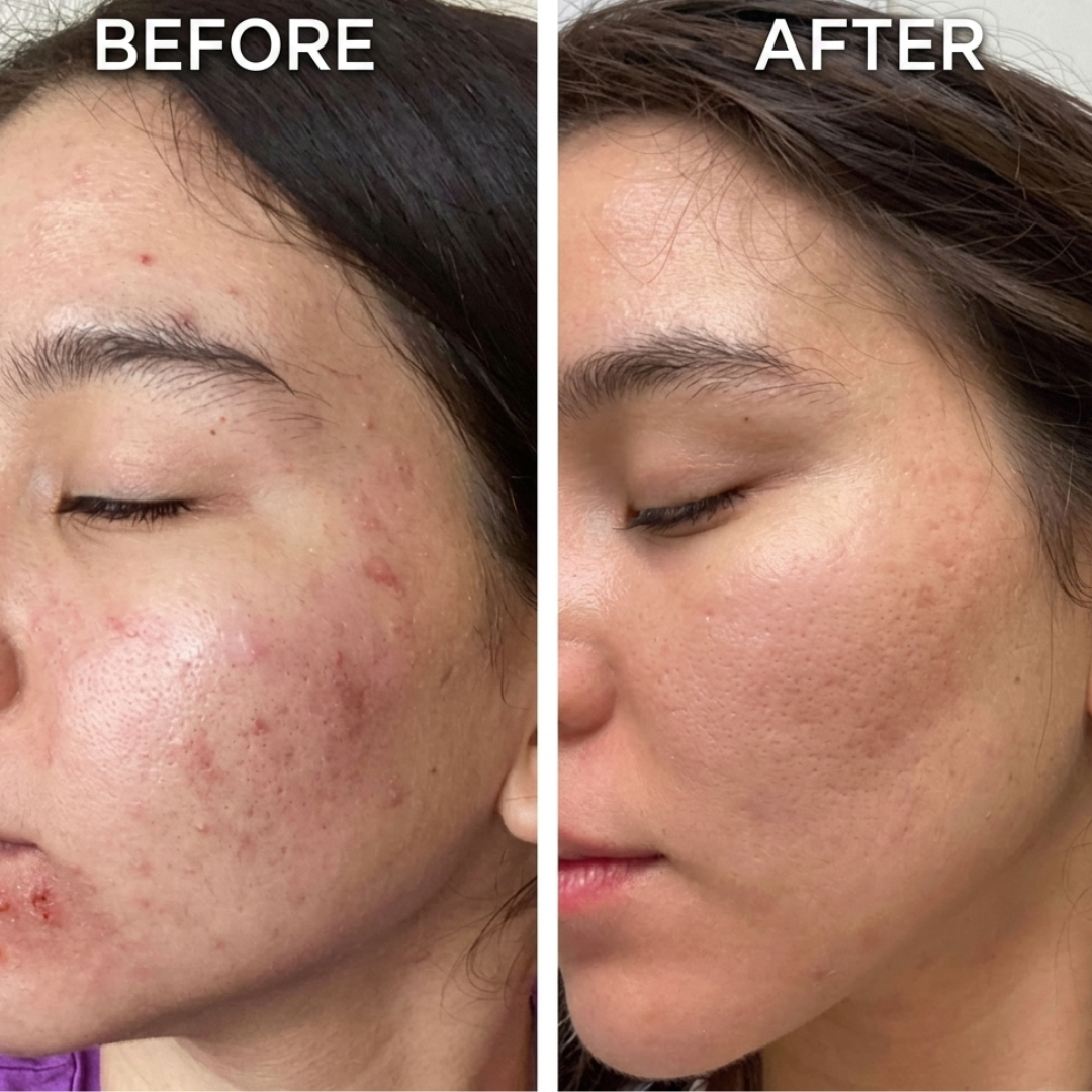 PAIR Acne Cream – Clears Acne, Fades Redness, Prevents New Breakouts – IPPN + IPMP Dual Action – Gentle, Non-Greasy, Dermatologically Tested