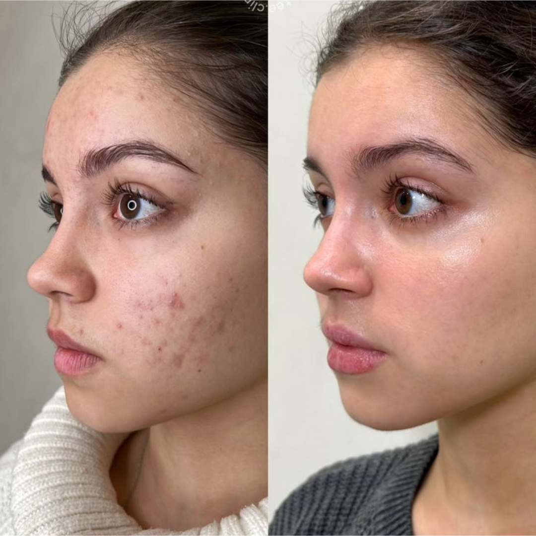 Conscious Chemist Acne Treatment Serum – Reduces Acne, Clears Spots, Smooths Skin – For Acne-Prone Skin